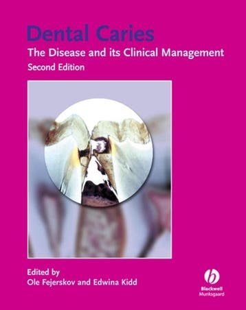 Dental Caries 9781405138895, Boeken, Zo goed als nieuw