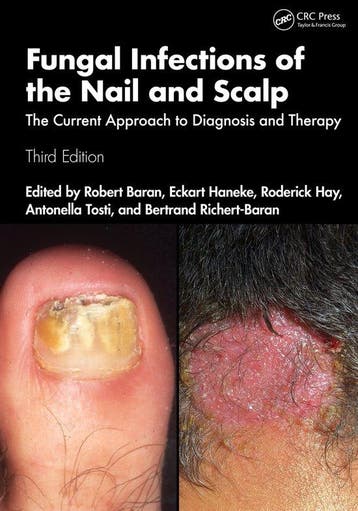 9781032464305 Fungal Infections of the Nail and Scalp, Boeken, Studieboeken en Cursussen, Verzenden, Nieuw, Antonella Tosti