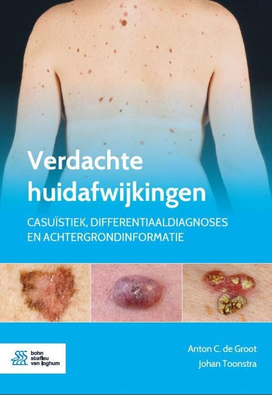 Verdachte huidafwijkingen 9789036824668 Anton  C. de Groot, Boeken, Wetenschap, Zo goed als nieuw, Verzenden