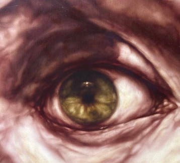 Alessandro Bellucco (1970) - Ipertrofie
