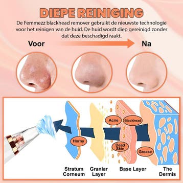 Premium Blackhead Remover I Poriënreiniger met 6, Ophalen of Verzenden, Zo goed als nieuw