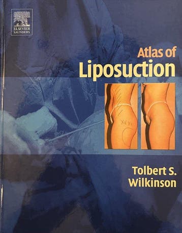 Atlas Of Liposuction - Tolbert S. Wilkinson 9780721694221, Verzenden, Gelezen, Tolbert S. Wilkinson
