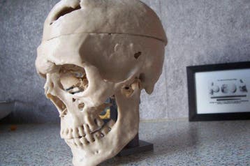 Anatomisch model - PLA - 2024 - Na de CT-scan van het