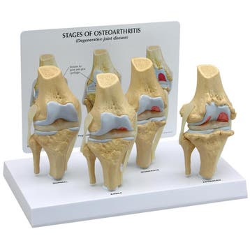 Anatomie model knie met artrose (4 stadia, 8x4x14 cm), Nieuw