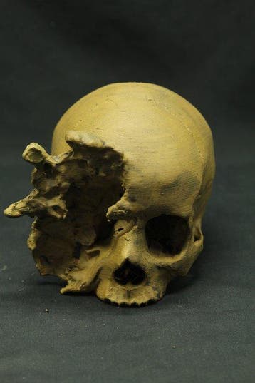 3D-geprint en afgewerkt beschadigde menselijke