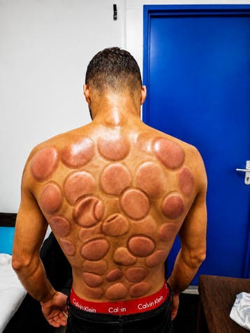 Cupping Therapy Den Bosh - Alleen mannen, Overige massages